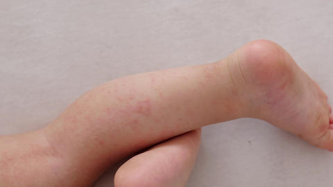 Eczema Rash On Baby Legs