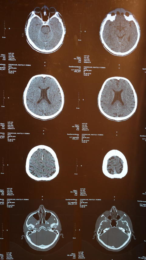 X-ray of the brain MRI in stroke Stock photo 24198396 | MotionElements