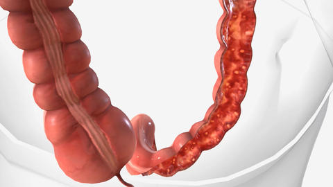 Ulcerative colitis is an inflammatory bowel dis Animated GIF 27659689 ...