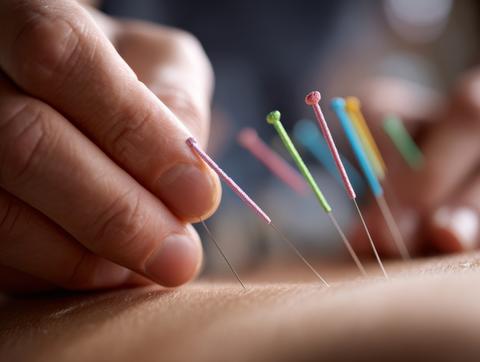 Acupuncture needles inserted into skin with colored tips