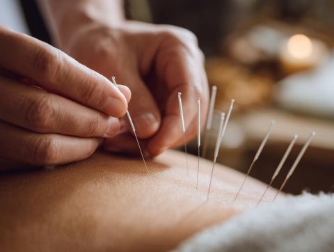 Close-up of acupuncture needles on the back