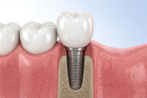 Dental implant with white crown and metal screw in pink gums