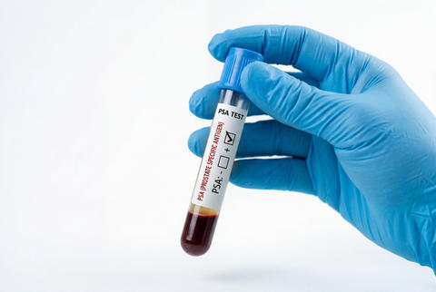 Gloved hand holding a blood sample tube labeled for PSA test
