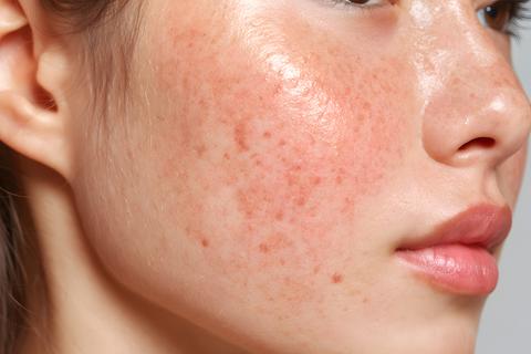 Detailed close up of human facial skin showing visible imperfections and redness on the cheek and no