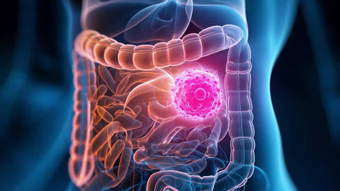 Cancer detection concept with transparent abdomen showing internal organs and