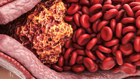 macro visualization inside a human blood vessel where a blockage forms and restricts normal blood