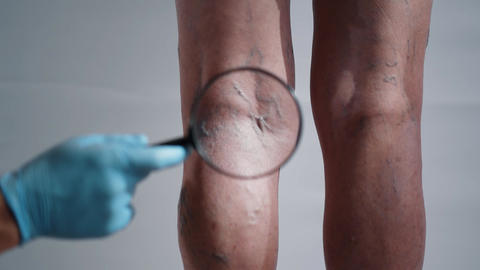 Doctor Inspecting Varicose Veins with Magnifying Glass