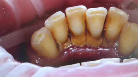 Teeth with heavy tartar buildup and bleeding gums, dental pathology close up