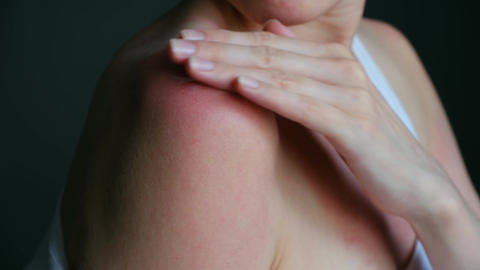 Woman applying cream on sunburned shoulder skin