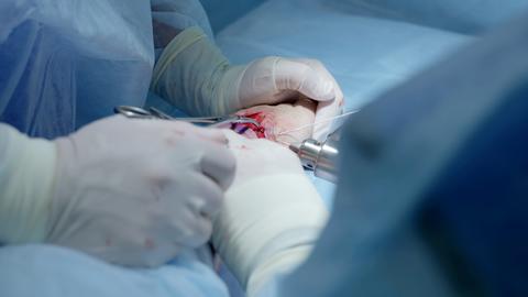 Russia Tomsk 05.07.2025: Orthopedic surgery process, Bone exposure and control